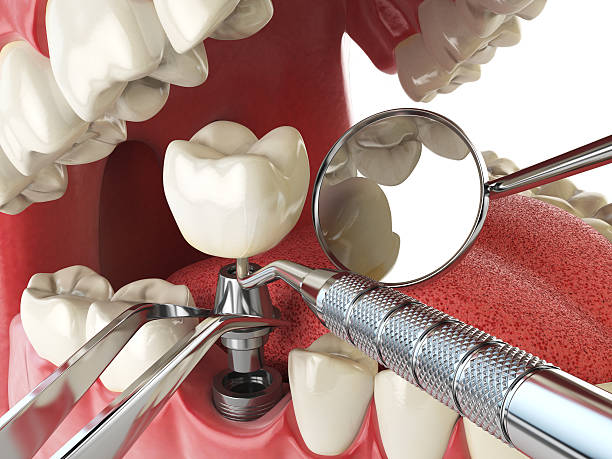 Best Emergency Broken Tooth Repair in Bogalusa, LA